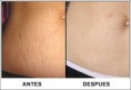 TRATAMIENTO PARA ESTRIAS
